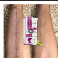 Acne Scar Removal Cream for Skin Repair and Healing